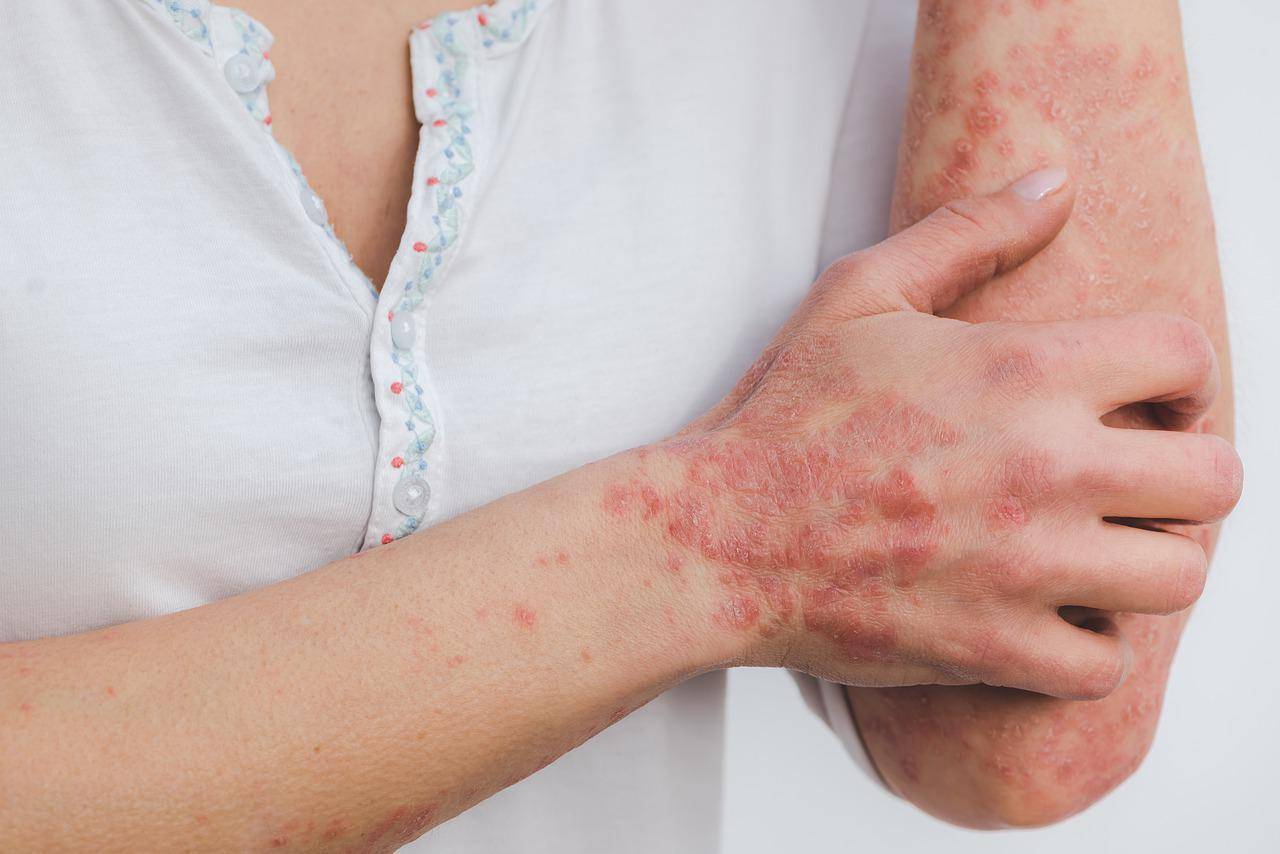 Traitez le psoriasis