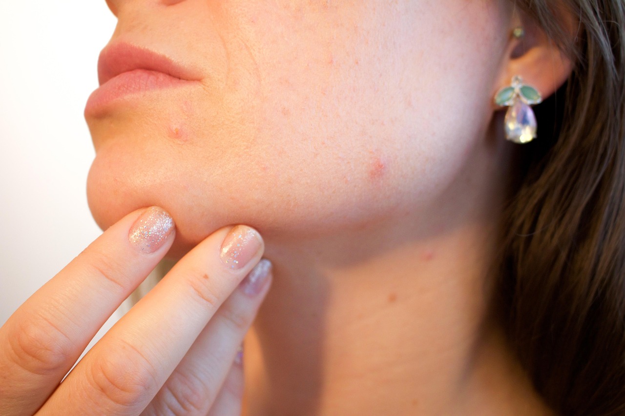 Acné, rougeurs, imperfections : Some by Mi a-t-il la solution miracle ?