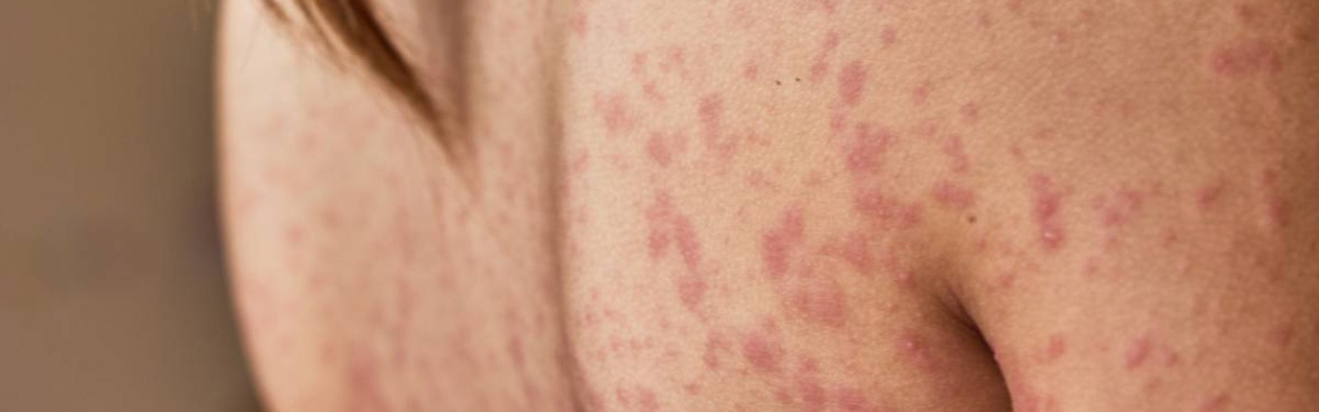 image-quels-traitements-pour-apaiser-le-psoriasis.jpg